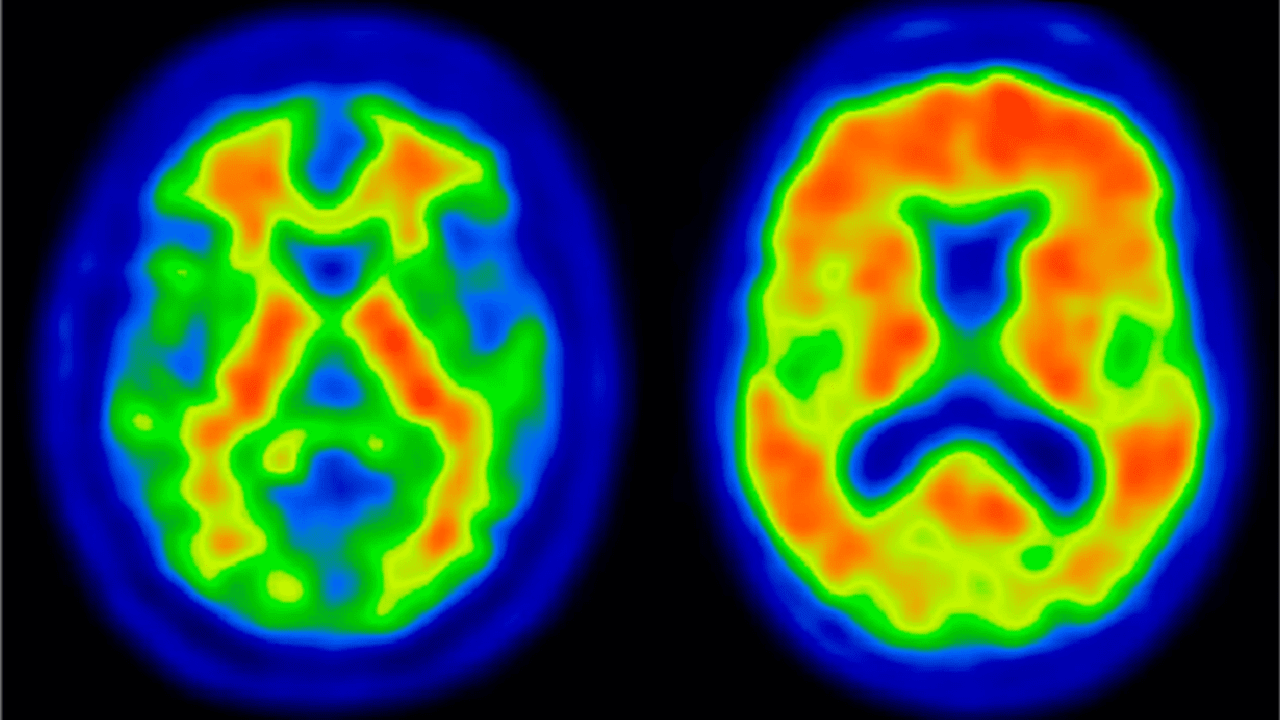 레켐비로 인한 '95% 매출 급증', 키순라로 이어질 것...듀켐바이오 최대... - 뉴스 썸네일 이미지